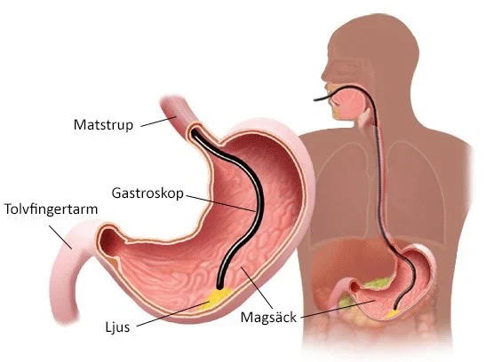 Svensk illustration som visar hur gastroskopet förs genom matstrupen till magsäcken och tolvfingertarmen