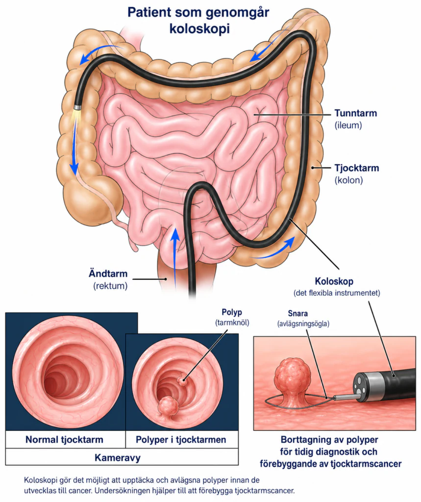 Svensk illustration av koloskopi, kamerabild och hur en polyp kan tas bort
